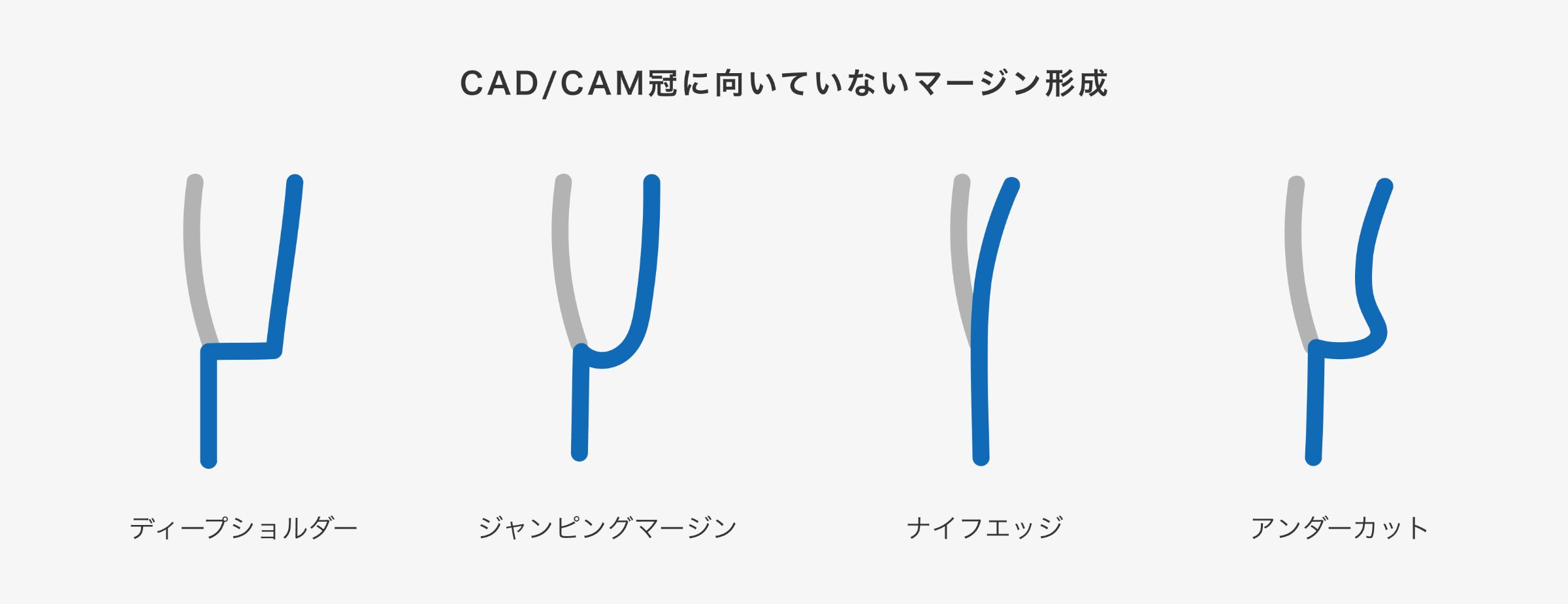 CAD/CAM冠に向いていないマージン形成(ディープショルダー/ジャンピングマージン/ナイフエッジ/アンダーカット)の図解