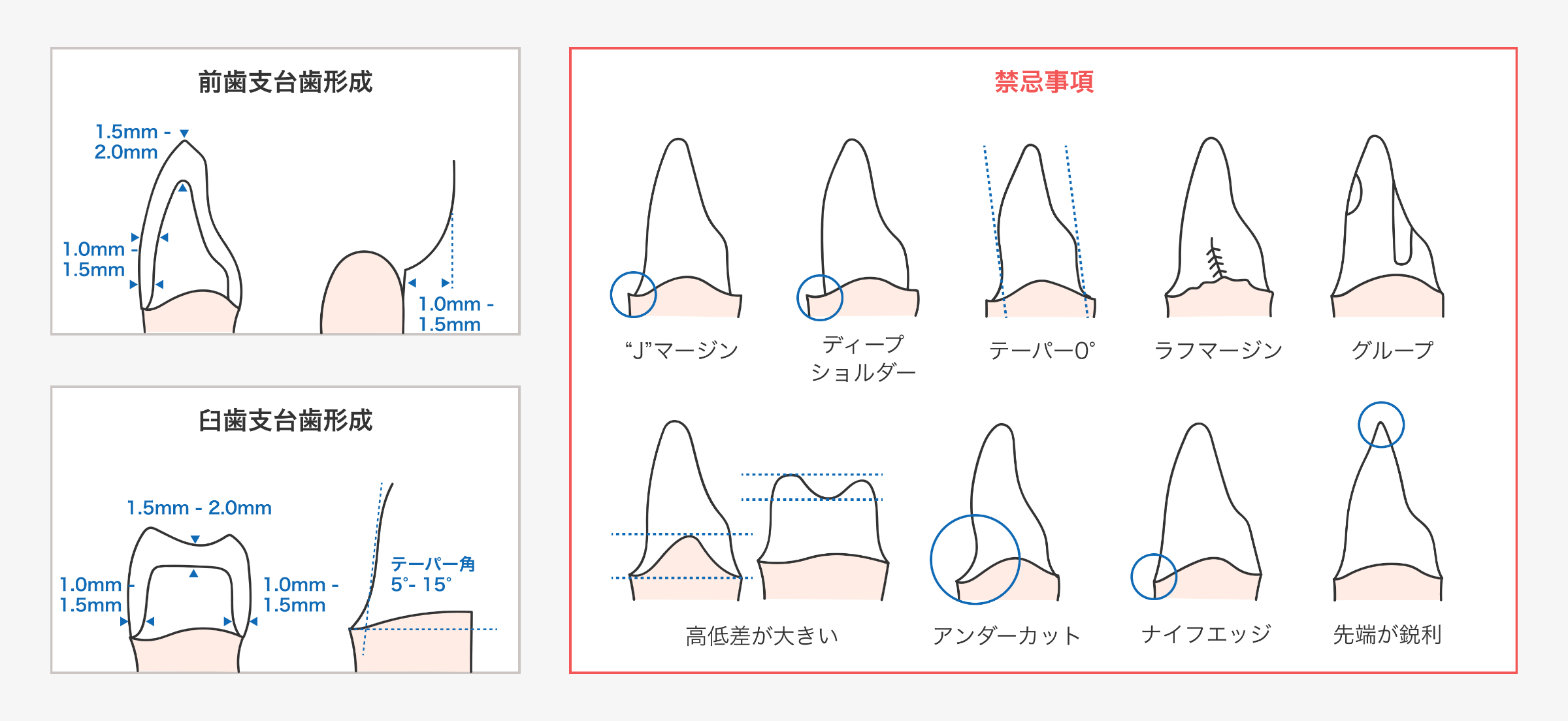 前歯・臼歯の支台歯形成の推奨寸法と禁忌事項の図解