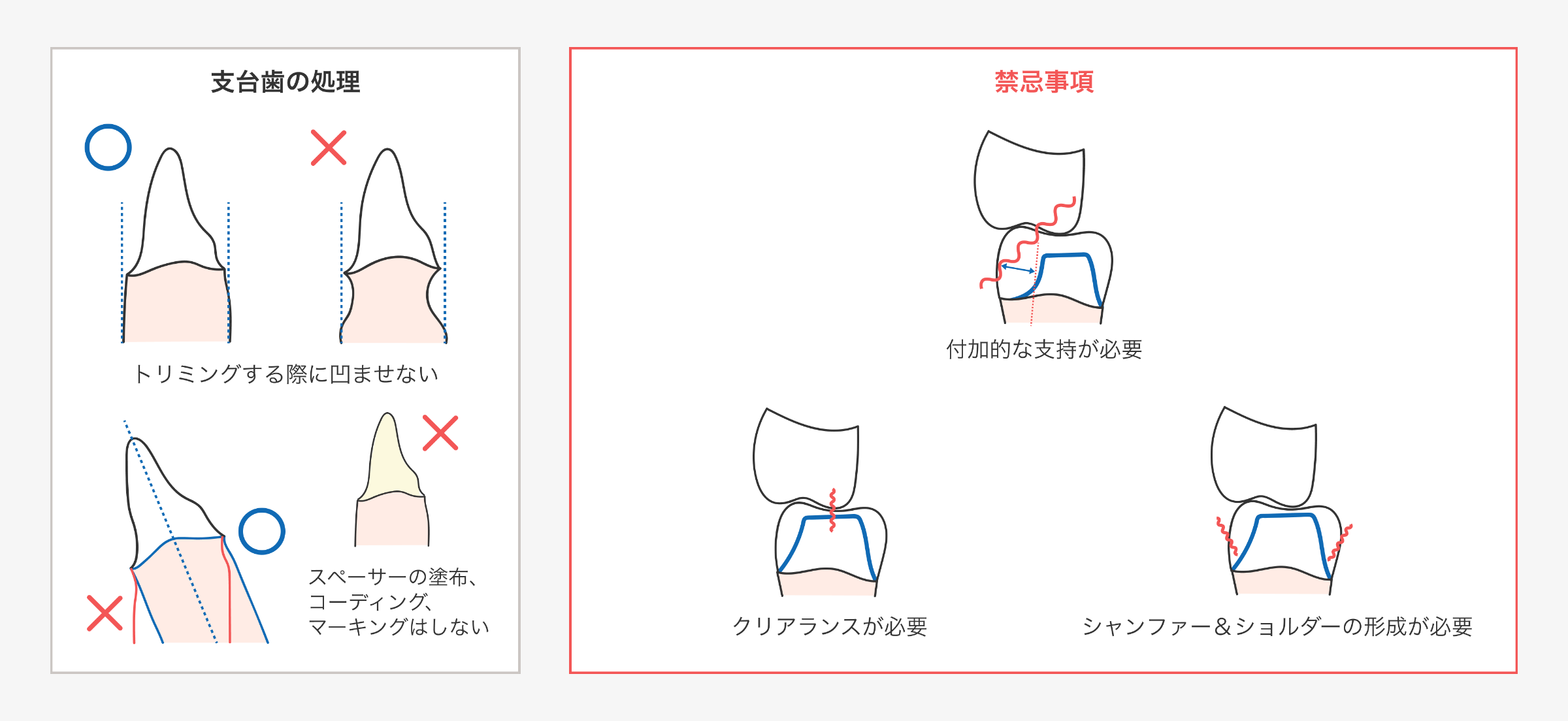 ラボサイドでの支台歯の処理と禁忌事項の図解